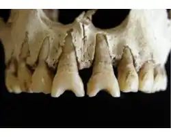 Dental_modification1-640x445-66704.jpg Dental_modification1-640x445-66704.jpg